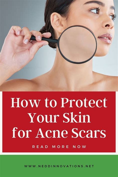 How To Get Rid Of Adult Acne Artofit