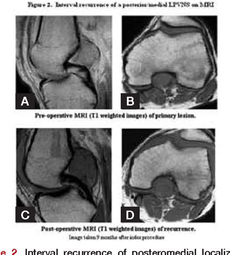 Figure From Arthroscopic Treatment Of Localized Pigmented