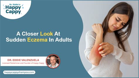 Eczema en los Adultos Una Mirada a la Dermatitis Atópica Dr Eddie s