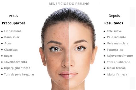 Como É Feito O Peeling - Peeling Químico - dra.leila lieva