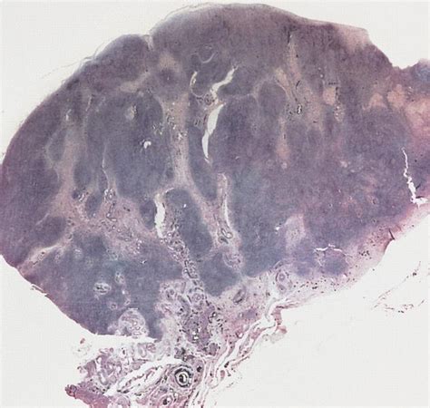 Pathology Outlines Stromal Hyperplasia And Hyperthecosis