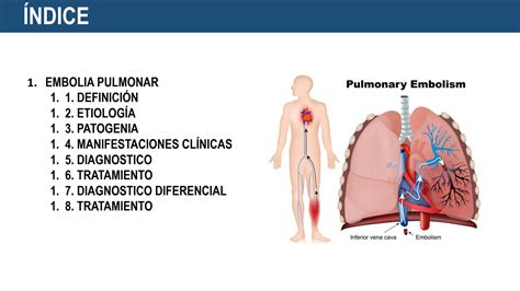 SOLUTION Embolia Pulmonar Medicina Pptx Studypool