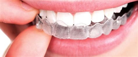 How Often Should I Wear My Invisalign Aligners