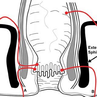 Figure demonstrating the Goodsall rule—when the external opening(s) is ...