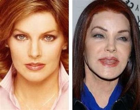 Priscilla Presley Before Surgery Plastic Surgery Success Or Fail