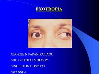 PPT - EXOTROPIA PowerPoint Presentation, free download - ID:3414230