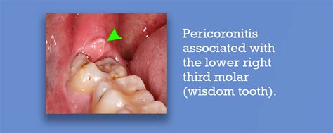 pericoronitis  symptoms  treatments carifree