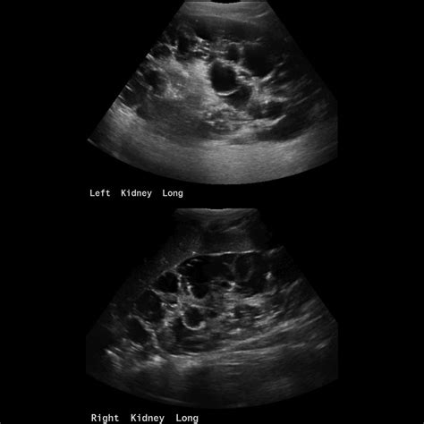 Pediatric Autosomal Dominant Polycystic Kidney Disease | Pediatric ...