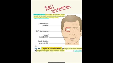 Bells Phenomenon Facial Palsy Why Only Lower Face Get Affected In Umn Lesion Youtube