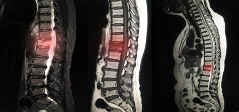 Vertebral Compression Fracture Guide By A Physical Therapist