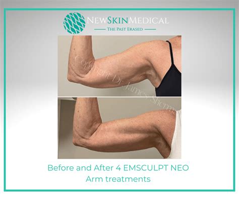 Before & After Emsculpt Neo | Target Fat & Stimulate Muscle