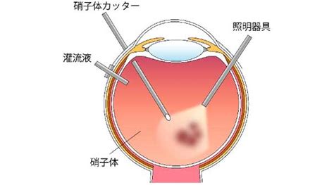 黄斑前膜の手術｜茨城県水戸市の小沢眼科内科病院