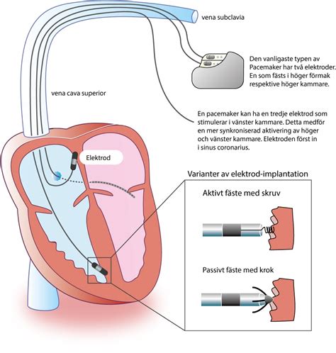 Pacemaker Mediated Tachycardia Pmt Ecg And Management The Cardiovascular