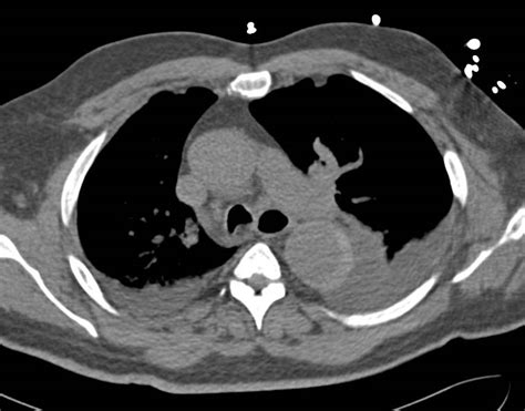 Aortic Dissection Ct Scan