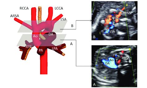 Fetal Transverse Views In A Case Of A Left Aortic Arch With An Aberrant