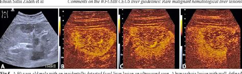 Figure From Comments And Illustrations Of The Wfumb Ceus Liver