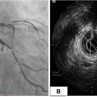 A) Mid-LAD Stenting done with 2.5 T 28 mm Absorb Stent (BVS). (B) LCX... | Download Scientific ...