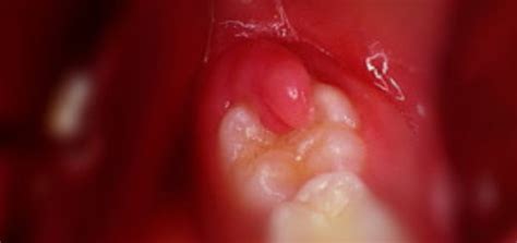 Pericoronitis Archives - Dr Sunil Dental Blog