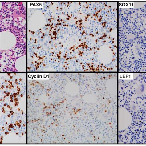 Bone Marrow Involvement By Cd Mantle Cell Lymphoma A Case Of