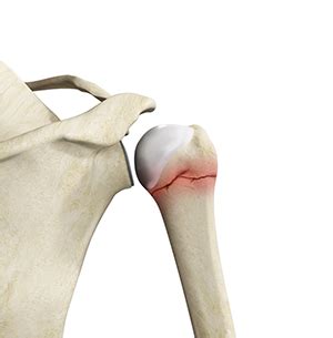 Humerus Surgical Neck Fracture Classification