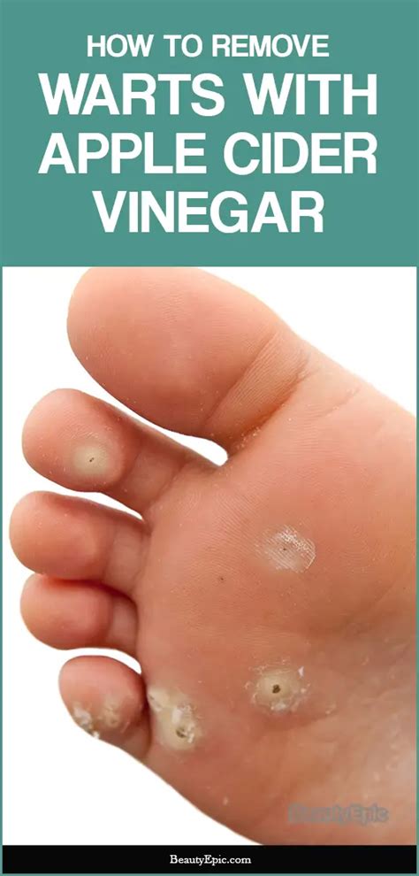 Apple Cider Vinegar For Wart Removal