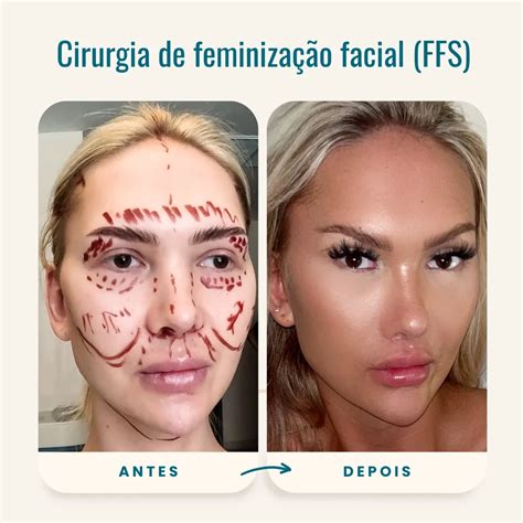 Feminização Facial Antes E Depois
