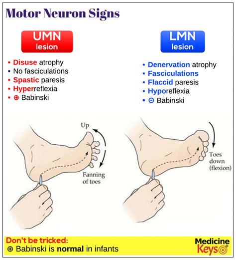 Motor Neuron Signs Medicine Keys For Mrcps