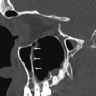 Coronal CT scan showing the components of the ostiomeatal unit: ethmoid... | Download Scientific ...