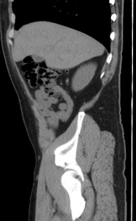 Subhepatic Position Of The Appendix Vermiformis Image Radiopaedia Org