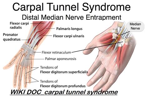 Carpal Tunnel Syndrome Wikidoc