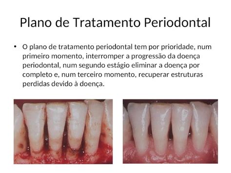 Ppt Plano De Tratamento Periodontal O Plano De Tratamento Periodontal