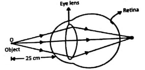 A Type Of Defect Of Vision Is Shown In The Diagram Write Any Two