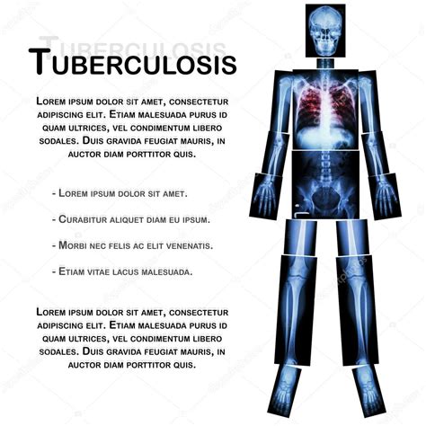 Tuberculosis pulmonar TB radiografía de todo el cuerpo cabeza