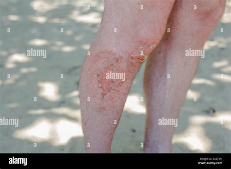 Grazed Knee Hi Res Stock Photography And Images Alamy