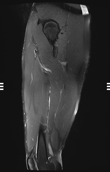 Hamstring Mri Normal Image