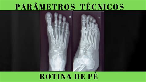 Rotina De Pé Parâmetros De Observação Para Uma Boa Radiografia Youtube