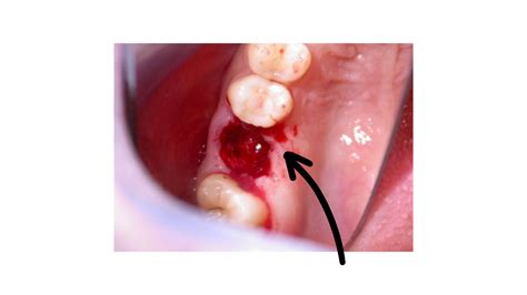 What does a blood clot after tooth extraction look like? Preventing ...