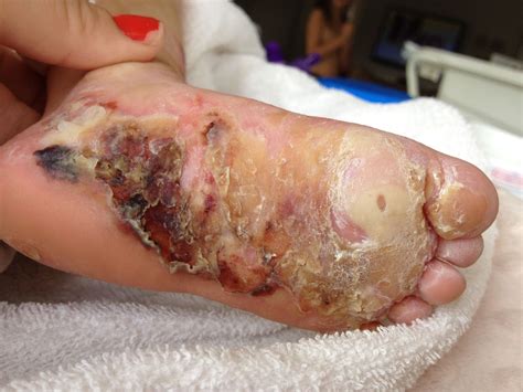 What Is Epidermolysis Bullosa Eb