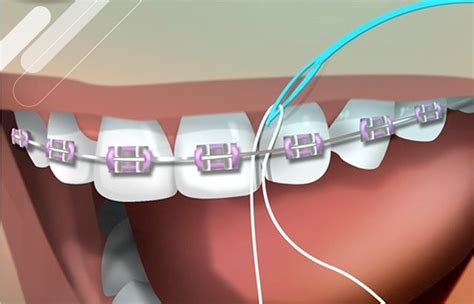 Fio Dental Para Aparelho Fixo O Guia Completo Encontre Um Dentista