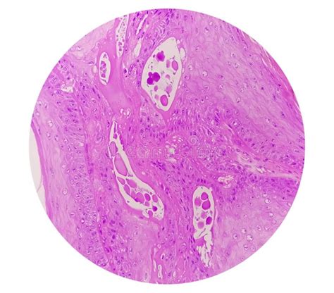 Photomicrography Of Squamous Hyperplasia Stock Image Image Of Disease