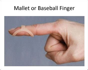 What Size Oval-8 Finger Splint Do I Need? - Oh My Arthritis