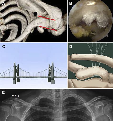 Comparison Of Hook Plate Fixation Versus Arthroscopic Coracoclavicular