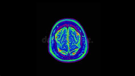 Human MRI Brain Scan on Black Background. Computed Tomography of the Human Brai Stock Footage ...