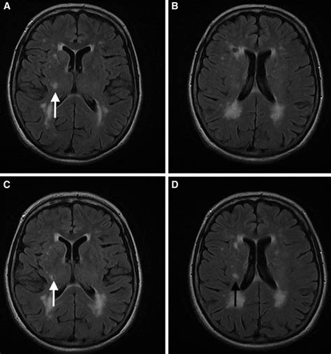 Long Term Morphological Changes Of Symptomatic Lacunar Infarcts And