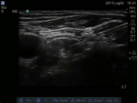 Femoral Nerve Block Ultrasound Guided