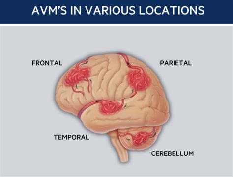 Arteriovenous Malformations Brain Aneurysm Foundation