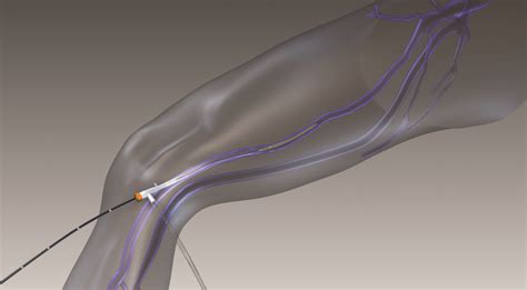 Traitement des varices par radiofréquence endoveineuse