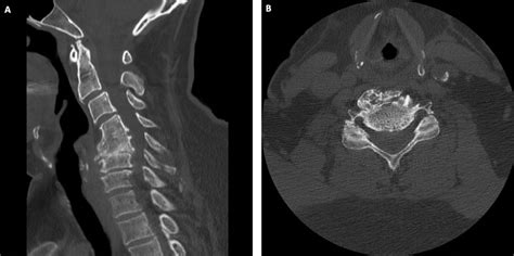 Cervical Myelopathy Clinical Tree