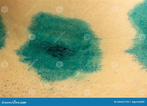 Surgical Suture With Brilliant Green After Laparoscopic Surgery On Abdomen Skin Stock Image