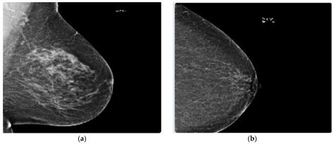 Information Free Full Text Breast Cancer Detection In Mammography